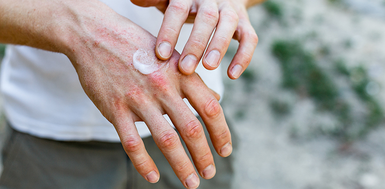 psoriasis 1 792x390px