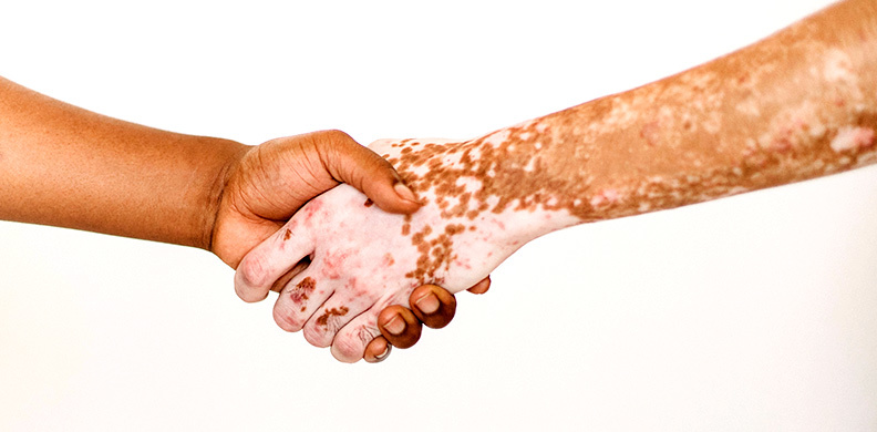 vitiligo haende