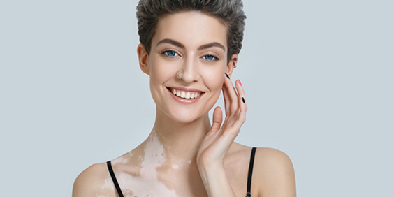 segmentale vitiligo 2 564x282px