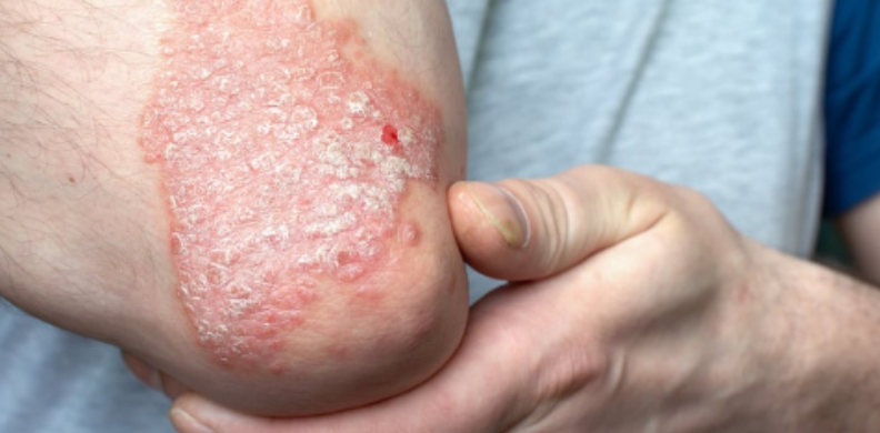 psoriasis schulung zugeschnitten web