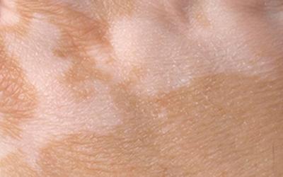 vitiligo welt