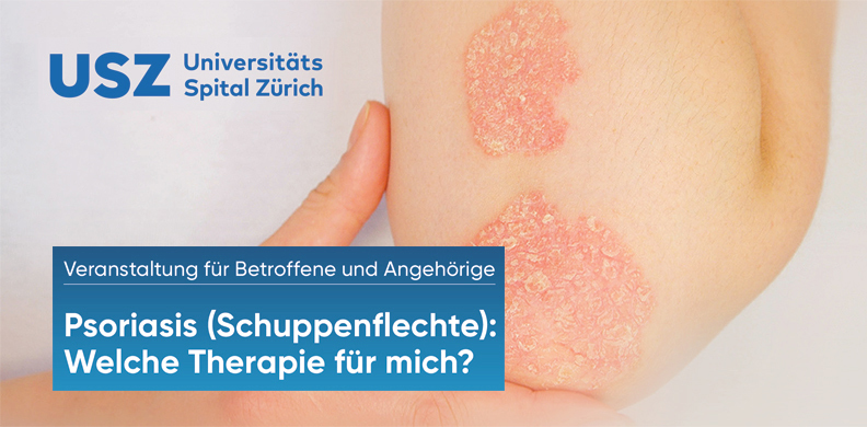 psoriasis usz